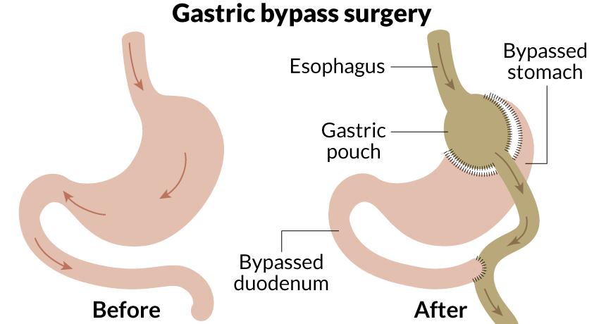 GASTRIC BYPASS